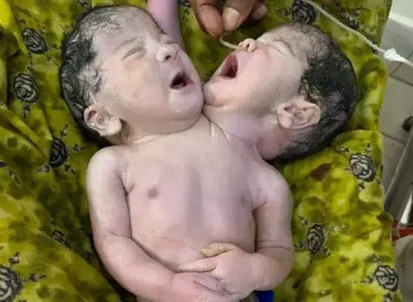 জন্মের ৩ ঘণ্টা পর মারা গেল  দুই মাথাওয়ালা শিশু