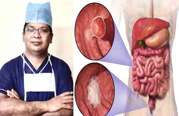 কোলোরেক্টাল ক্যান্সারের লক্ষণ ও প্রতিকারের উপায়