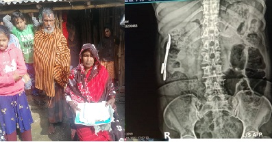 বাছেনা খাতুনের চিকিৎসার ঘটনায় ৩ সদস্যের তদন্ত কমিটি গঠিত