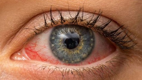 চোখ ওঠা: ছড়িয়ে পড়ছে সর্বত্র