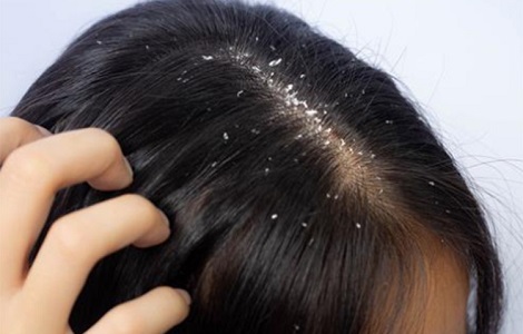 শীতকালে বেড়ে যায় মাথার খুশকি