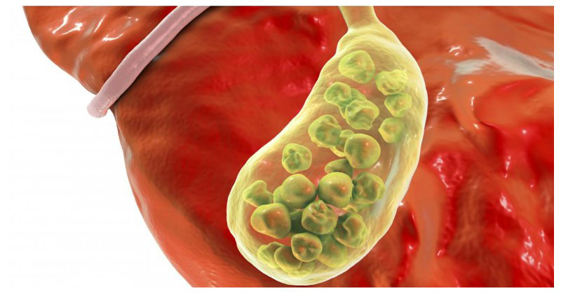 গলব্লাডারে স্টোনের ঝুঁকি এড়ানো যায় যেভাবে!