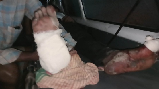 কুড়িগ্রামে কুড়িয়ে পাওয়া মর্টারশেল বিস্ফোরণে এক ব্যক্তির গোড়ালী বিচ্ছিন্ন