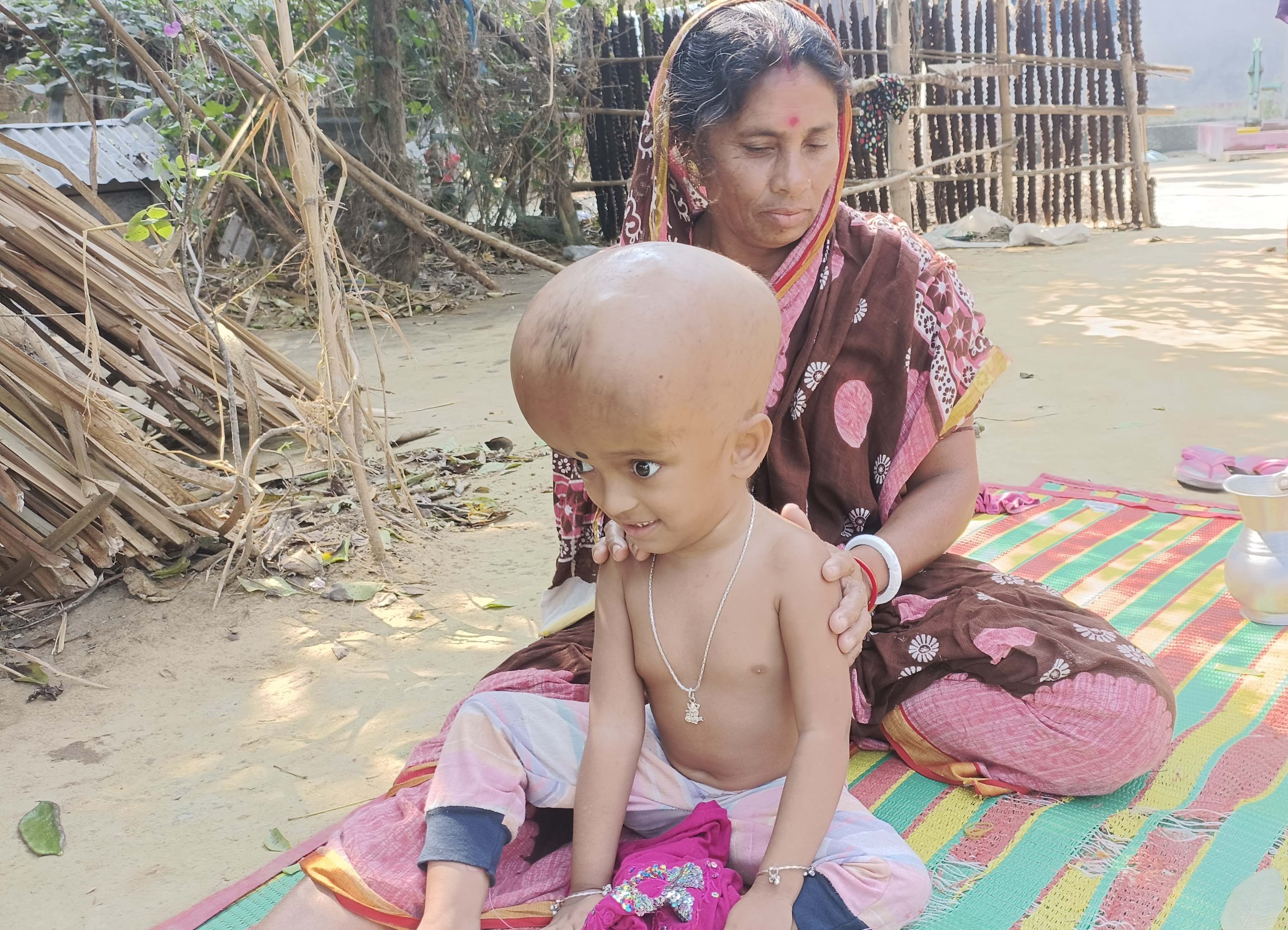 টাকার অভাবে থেমে গেছে শিশু সম্পূর্নার চিকিৎসা