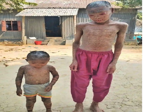 ফরিদপুরের আলফাডাঙ্গায়  বিরল রোগে ২ সহোদর  আক্তান্ত