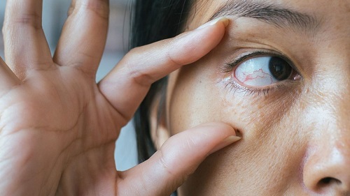 চোখে রক্ত চলাচল ব্যাহত হলে বাড়ে প্রেশার, নষ্ট হতে পারে দৃষ্টিশক্তি