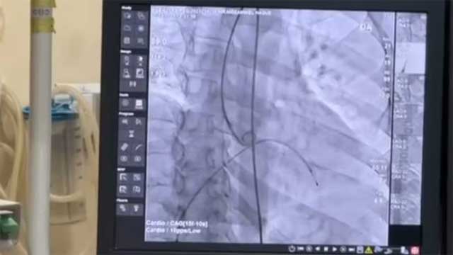 হার্টের ১১ ধরনের রিংয়ের দাম কমালো সরকার